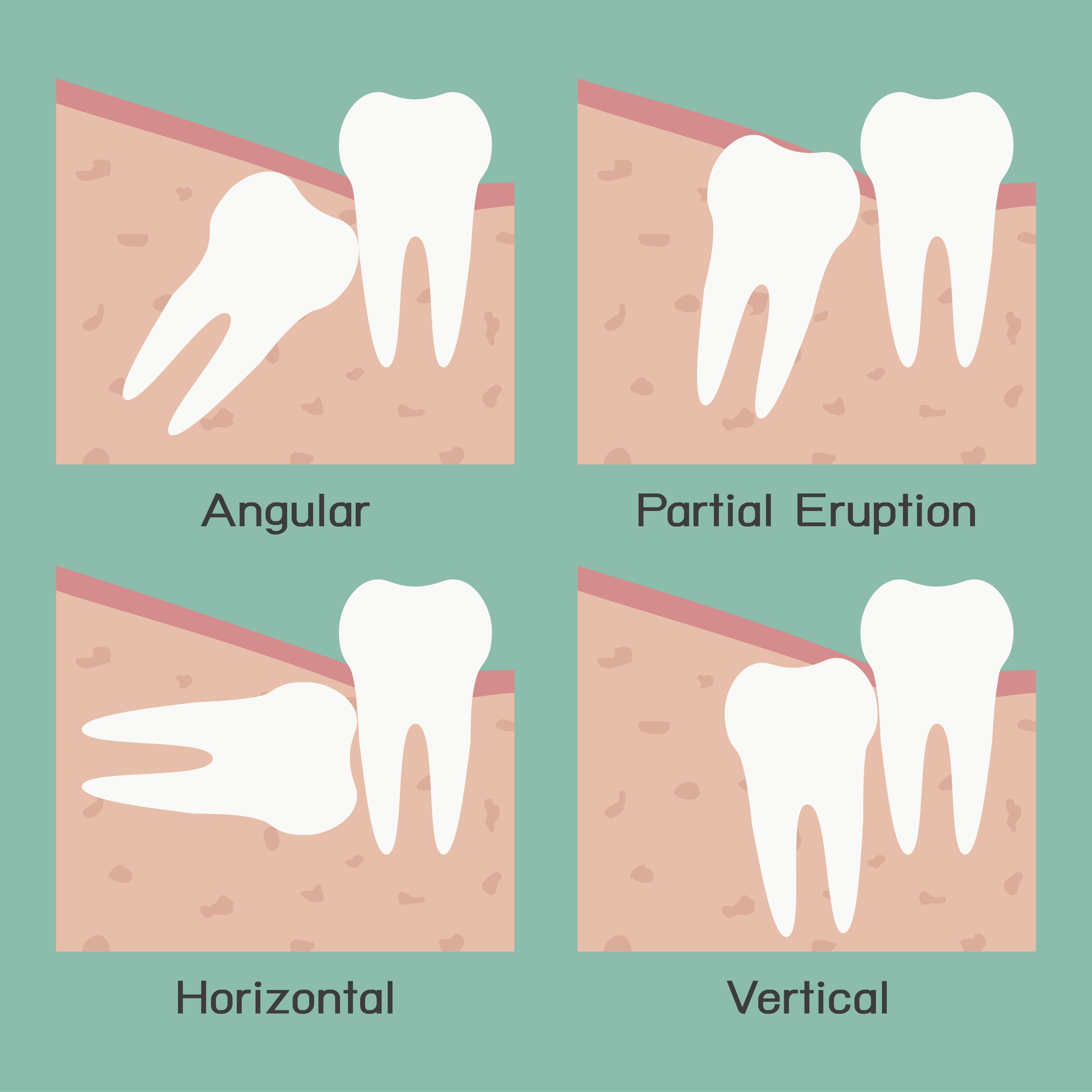 Extraction, Bone Grafting & Wisdom Teeth Draper Walter Meden DDS