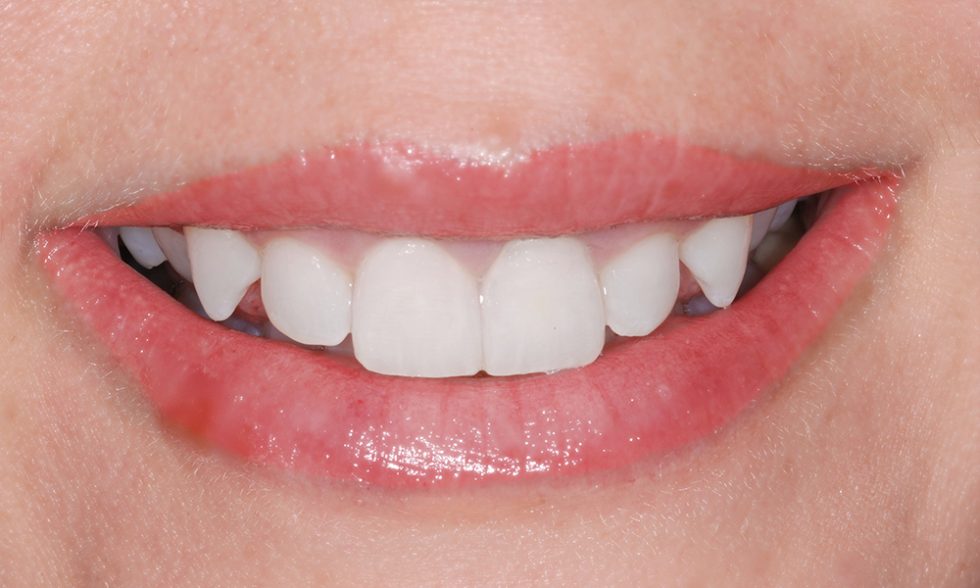 Gummy Smile - Elite Smiles Dentistry