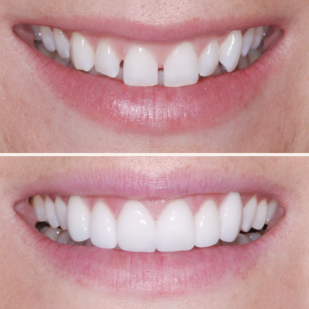 Patient results porcelain veneers before and after 