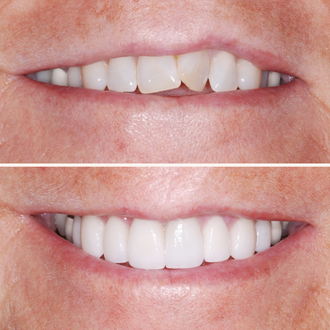 Patient results porcelain veneers before and after 