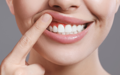 Optimal Gummy Smile Correction: Surgical Treatment vs. Botox and Fillers