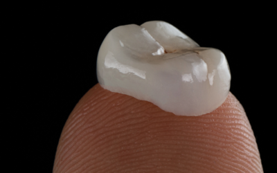 My Dental Crown Came Off: What To Do and How To Prevent It