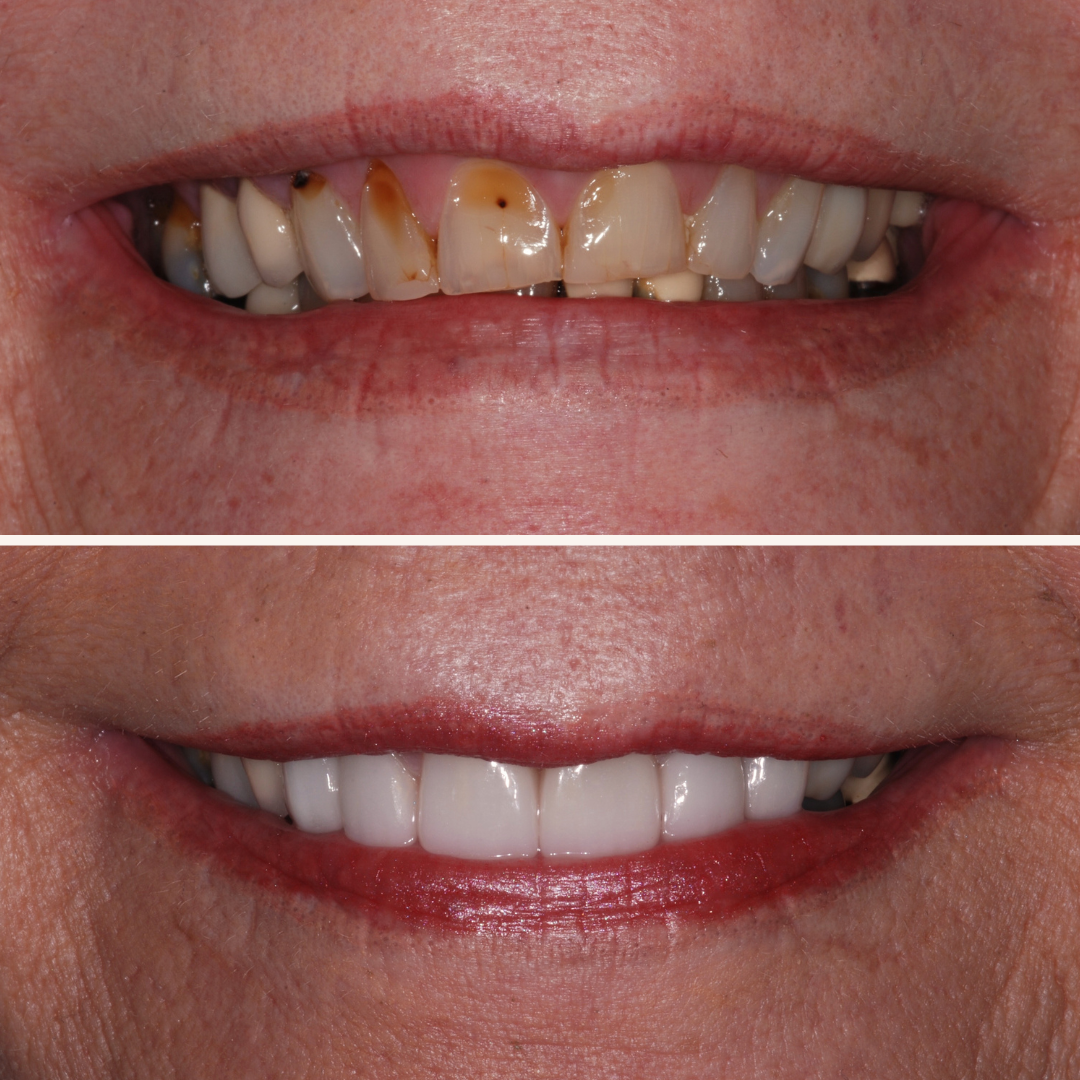 Porcelain Veneers Before & After