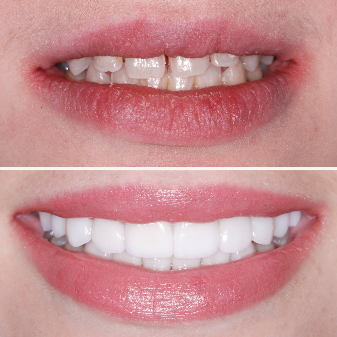 Porcelain Veneers Before & After