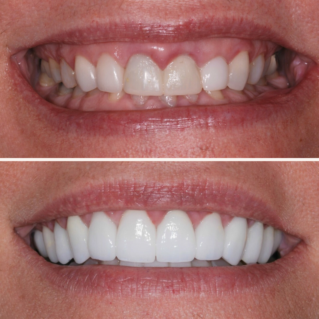 Patient results porcelain veneers before and after 