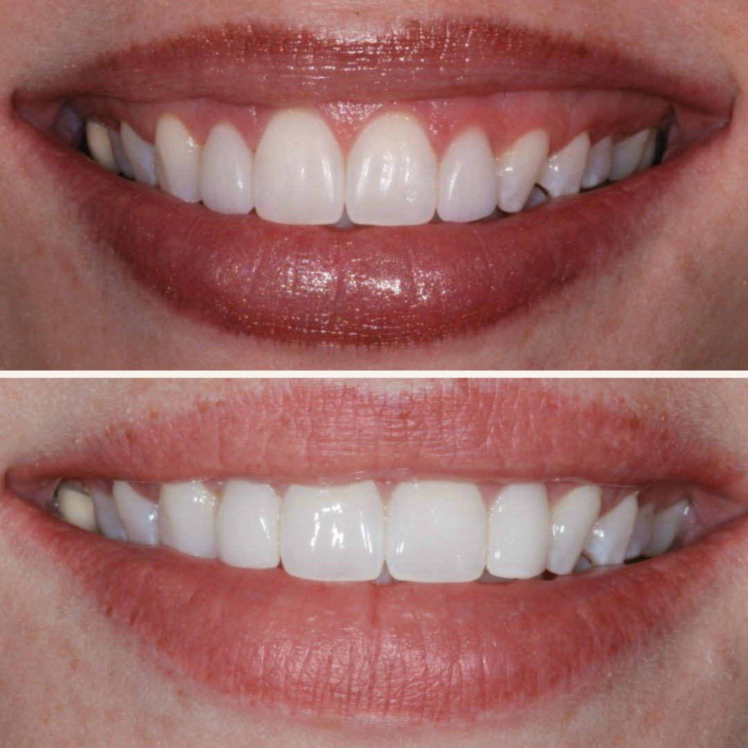 Patient results porcelain veneers before and after 