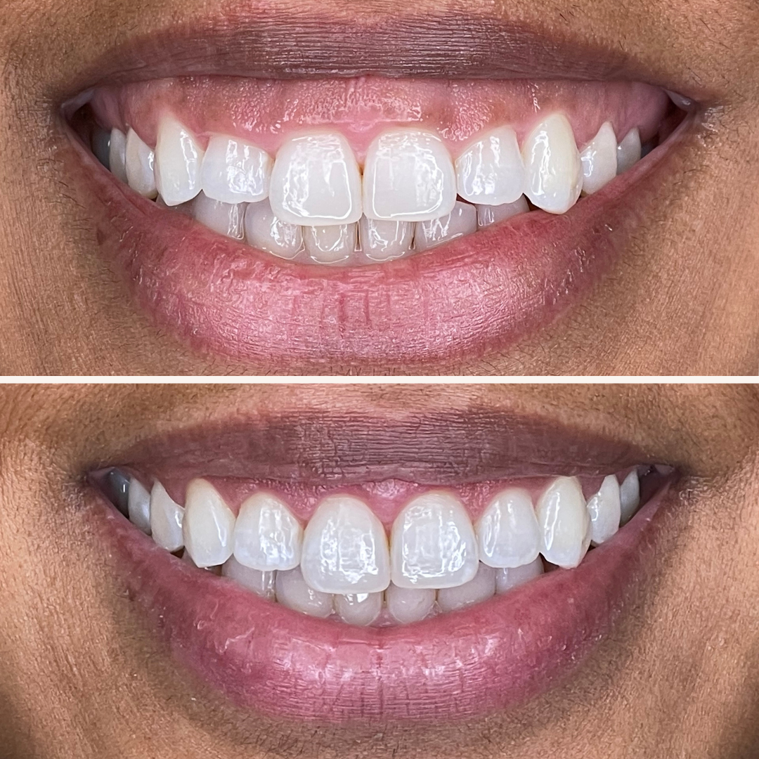 Patient results porcelain veneers before and after 