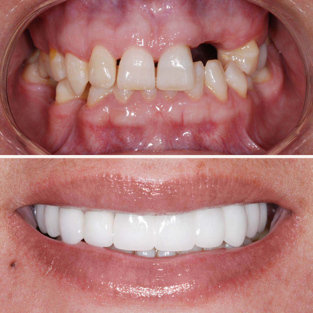 Patient results porcelain veneers before and after 