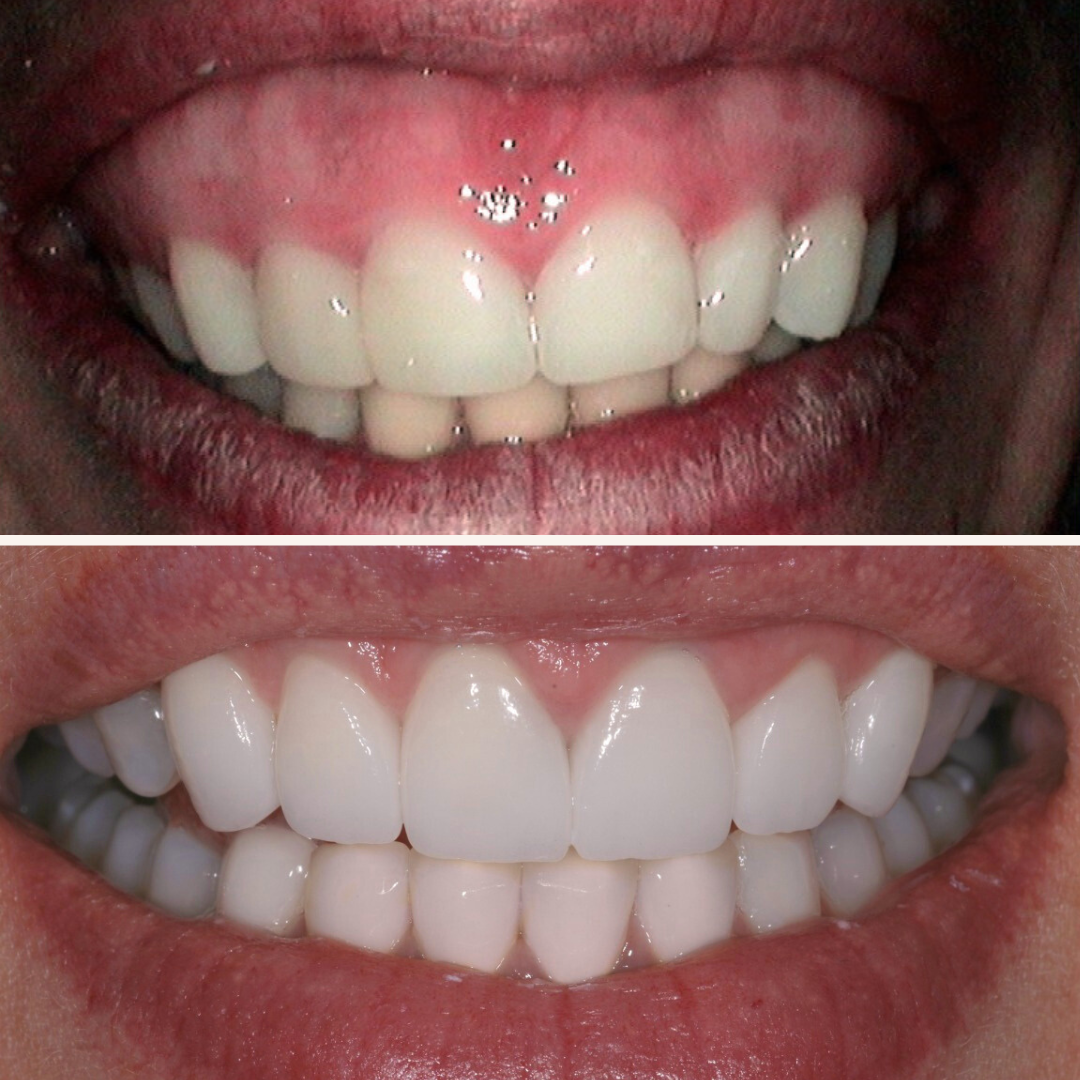 Patient results porcelain veneers before and after 