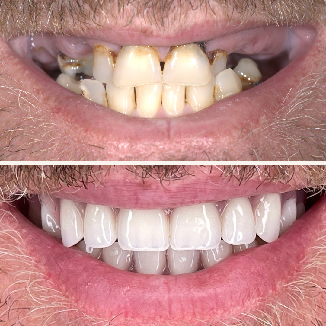 Patient results porcelain veneers before and after 