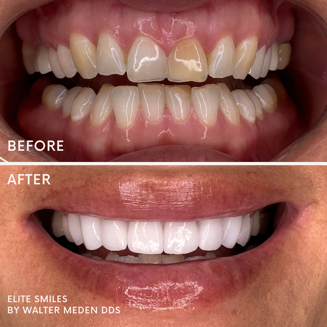 Porcelain Veneers Before & After