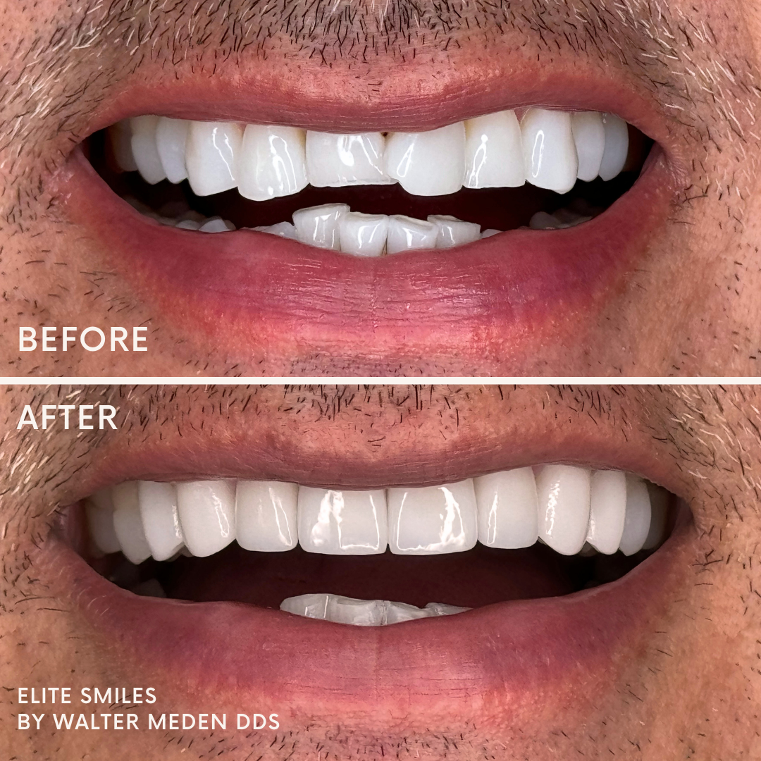 Porcelain Veneers Before & After