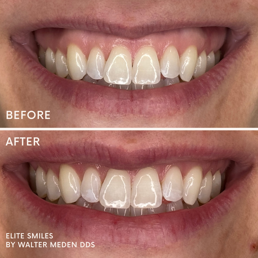 Patient results porcelain veneers before and after 