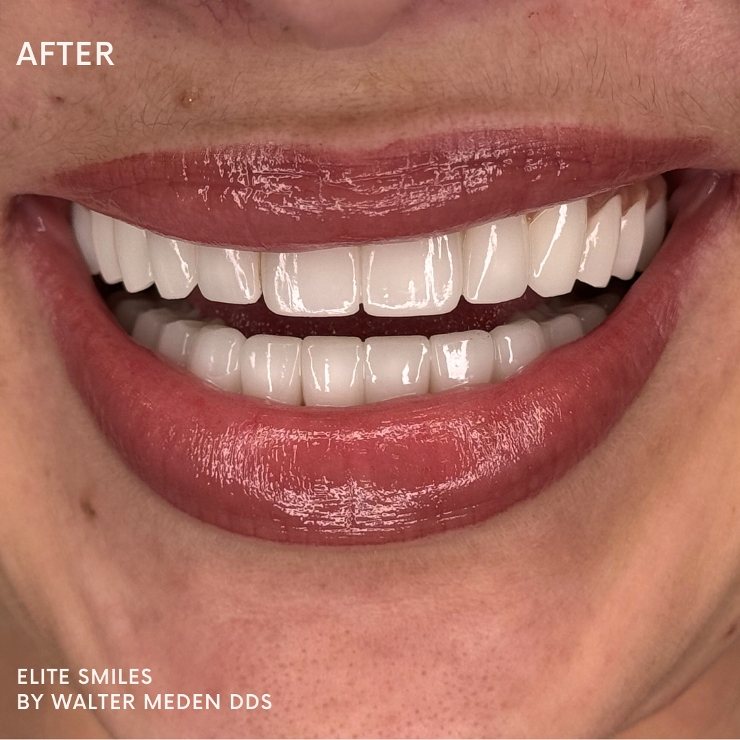 Patient results porcelain veneers before and after 