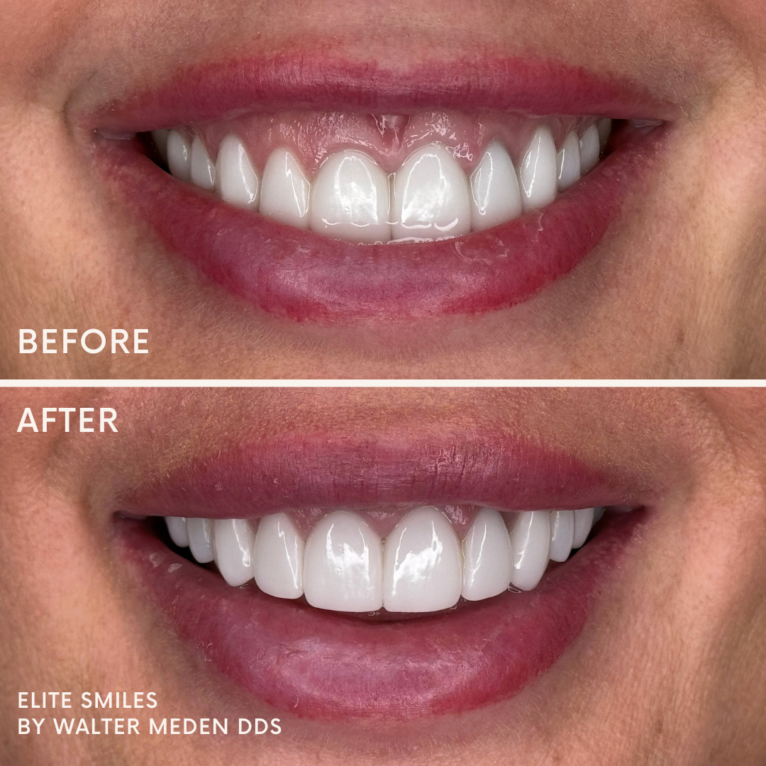 Patient results porcelain veneers before and after 