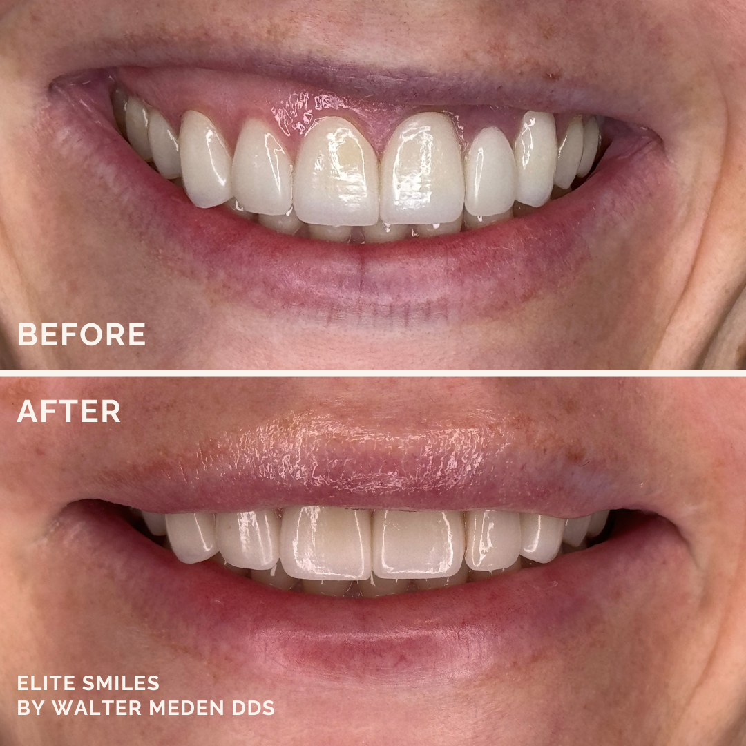 Gummy smile treatment through lip repositioning